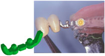 OT Cap Attachments for partial dentures