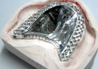 Removable cast partial dentures