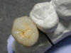 Aesthetic and high quality porcelain restoration