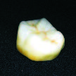 Czar FZ - Solid Zirconia Crown or Bridge