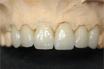 IPS e.max dental Crowns