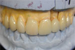 IPS e.max Laminates and Dental Crowns