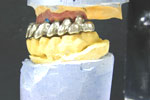 Different types of dental implants