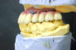 Dental implant systems