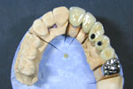 Hybrid Screw retained dental implant