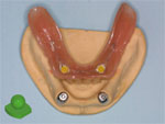 Attachments for Overdentures