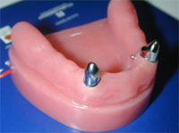 Primary telescopes on natural teeth