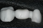 Procera dental restoration