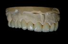 Zirconia dental restorations