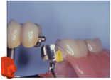 OT Strategy for partials dentures