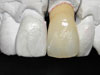 Finest dental Ceramics