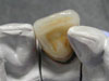 Porcelain fused to metal crown and bridge restoration