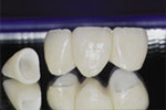 IPS e.max Dental Bridge and Crown