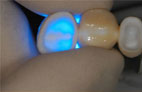 Procera Zirconia for metal free restorations