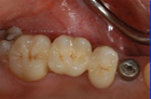 dental restoration