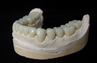 Procera Zirconia restorations