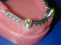 Tertiary framework in Cobalt Chrome bonded to galvano crowns